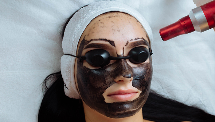 Carbon Facial Treatment