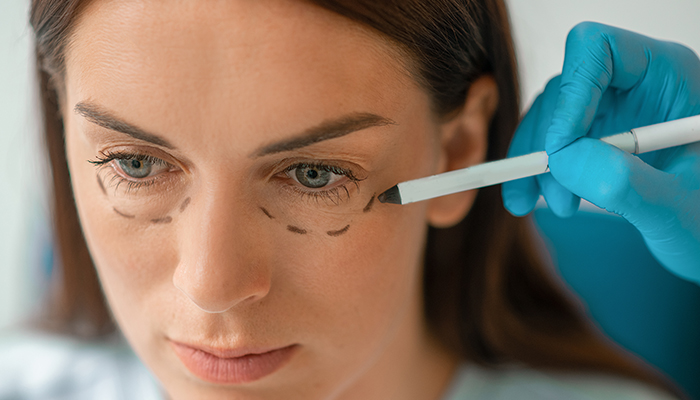 Dark Circles PRP Treatment