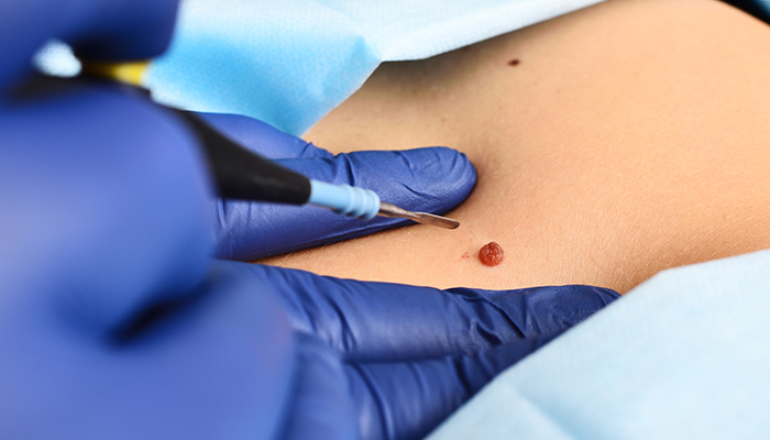 Mole Removal Procedure