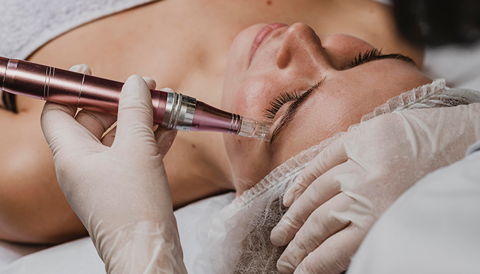 PRP with Microneedling Treatment