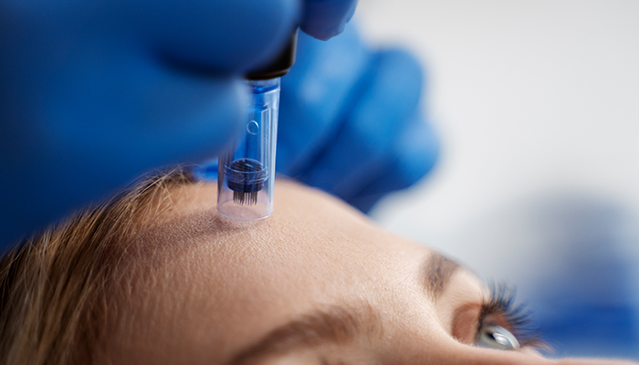 PRP Microneedling Procedure